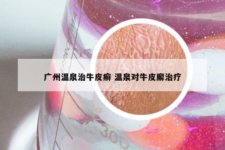 广州温泉治牛皮癣 温泉对牛皮廨治疗