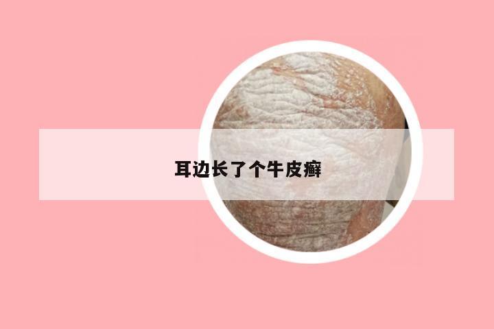 耳边长了个牛皮癣