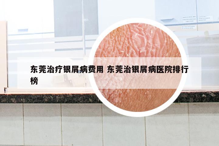 东莞治疗银屑病费用 东莞治银屑病医院排行榜