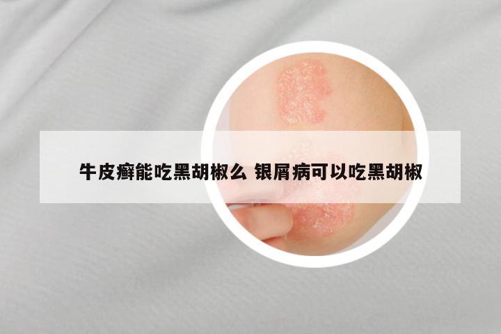 牛皮癣能吃黑胡椒么 银屑病可以吃黑胡椒
