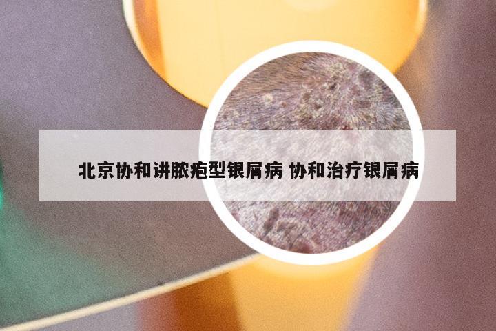 北京协和讲脓疱型银屑病 协和治疗银屑病