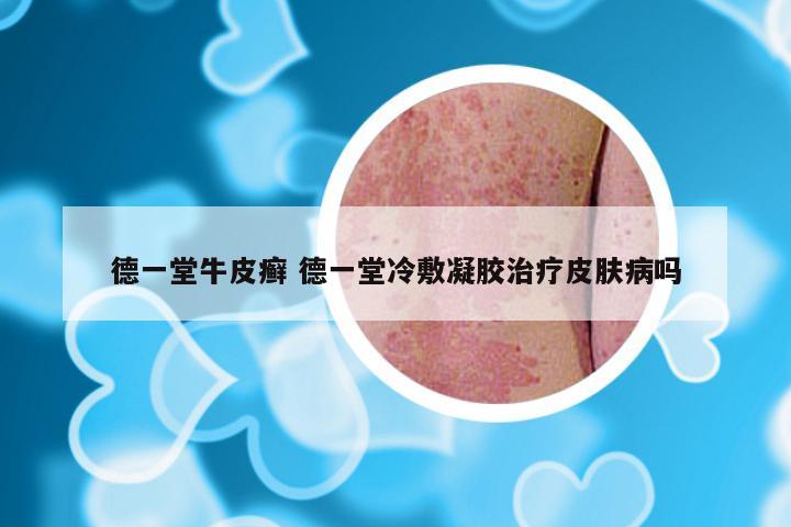 德一堂牛皮癣 德一堂冷敷凝胶治疗皮肤病吗