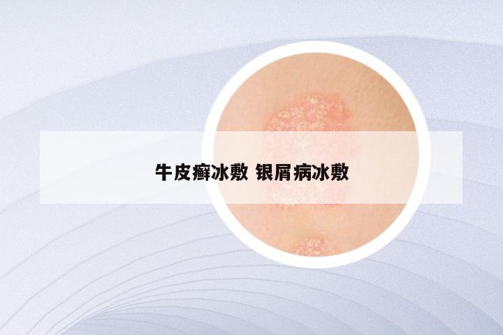 牛皮癣冰敷 银屑病冰敷