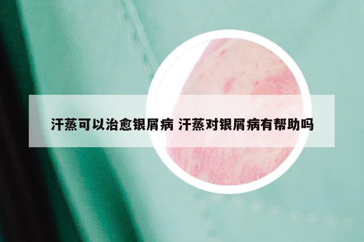 汗蒸可以治愈银屑病 汗蒸对银屑病有帮助吗