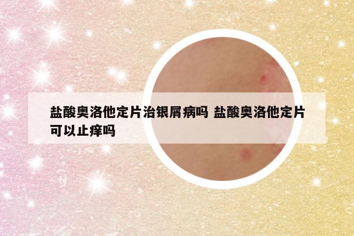 盐酸奥洛他定片治银屑病吗 盐酸奥洛他定片可以止痒吗