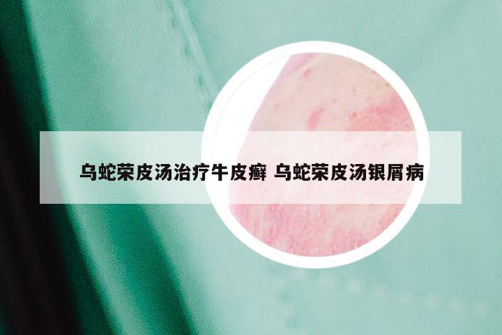 乌蛇荣皮汤治疗牛皮癣 乌蛇荣皮汤银屑病