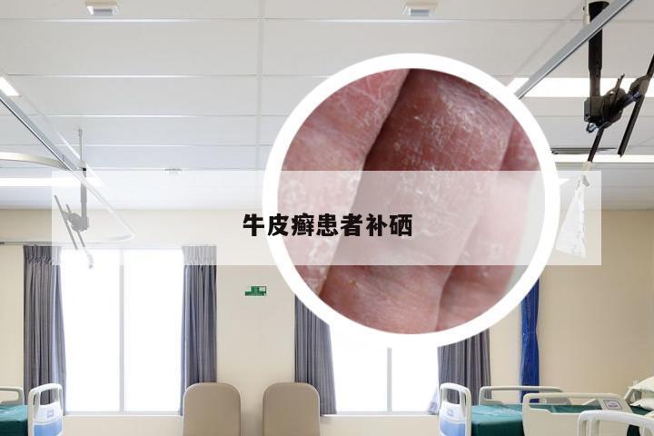 牛皮癣患者补硒