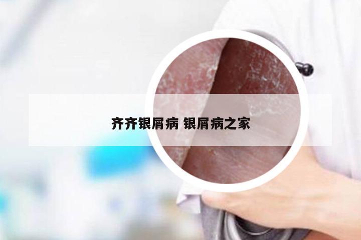 齐齐银屑病 银屑病之家