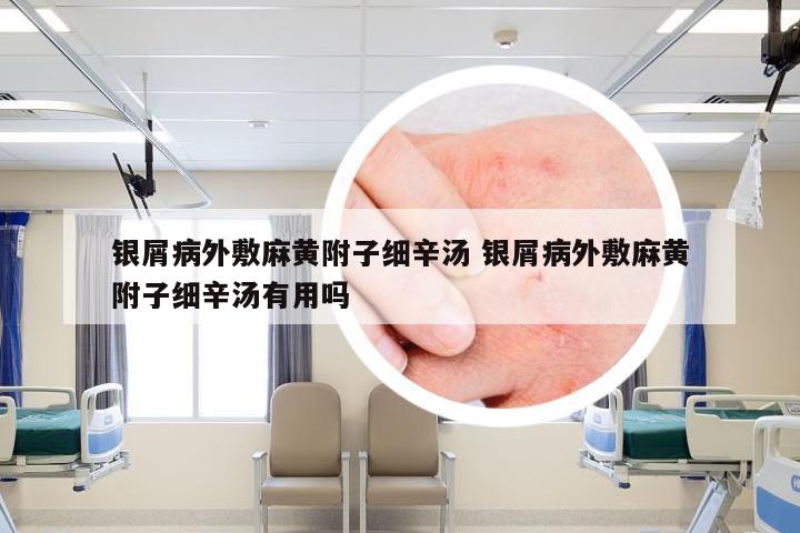 银屑病外敷麻黄附子细辛汤 银屑病外敷麻黄附子细辛汤有用吗