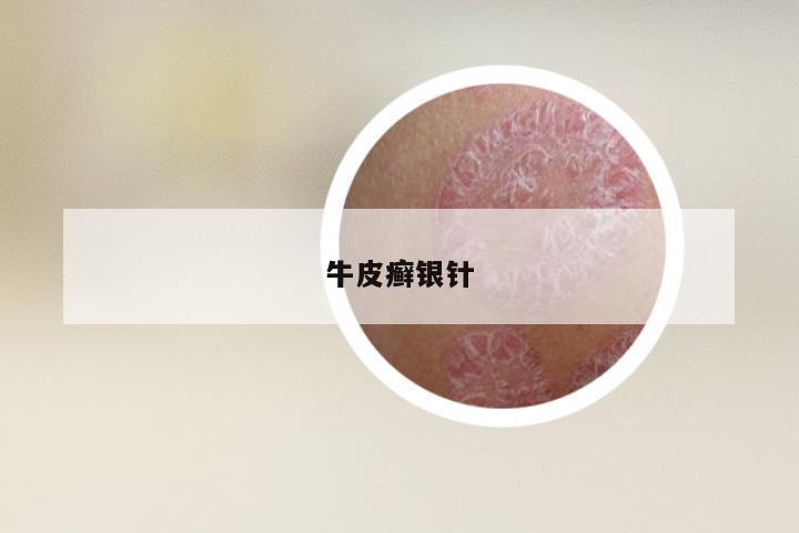 牛皮癣银针