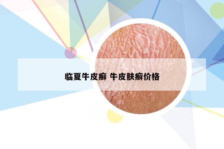 临夏牛皮癣 牛皮肤癣价格