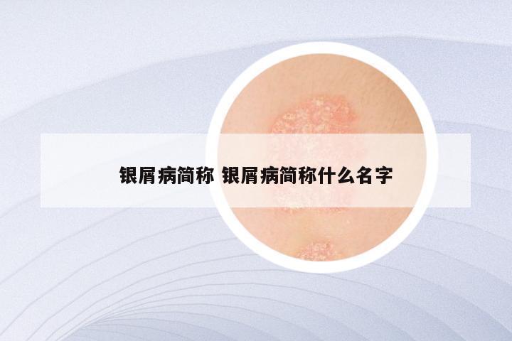 银屑病简称 银屑病简称什么名字