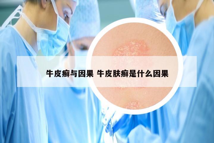 牛皮癣与因果 牛皮肤癣是什么因果