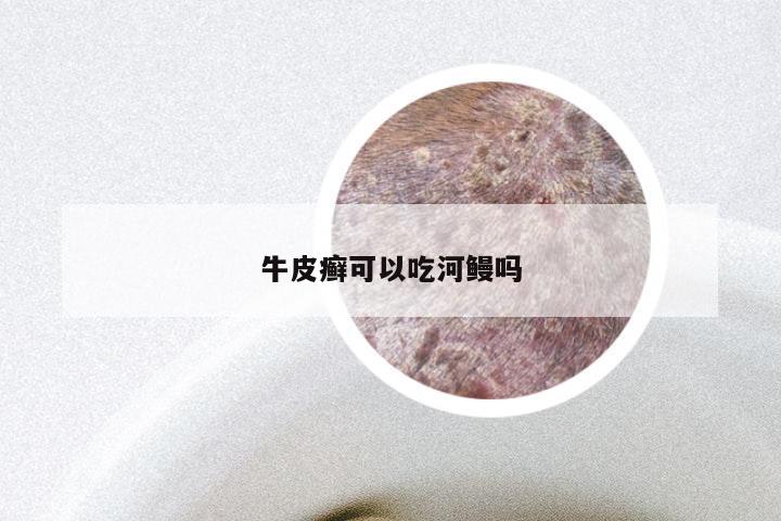 牛皮癣可以吃河鳗吗