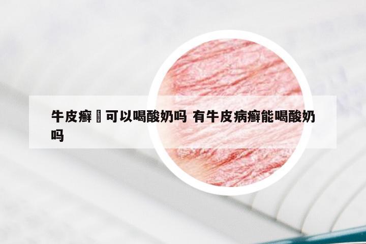 牛皮癣廯可以喝酸奶吗 有牛皮病癣能喝酸奶吗