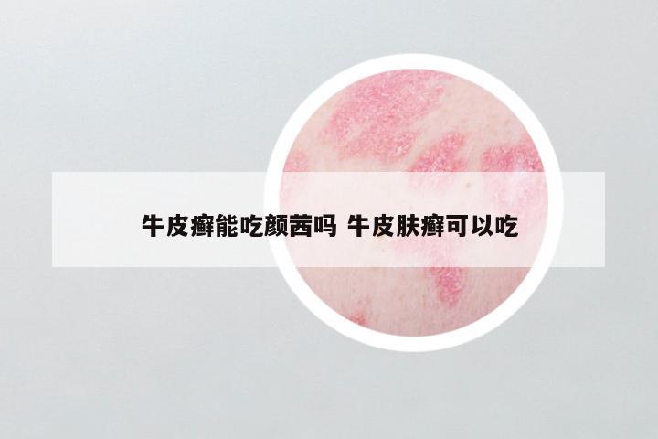 牛皮癣能吃颜茜吗 牛皮肤癣可以吃