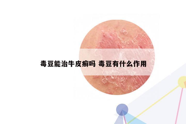 毒豆能治牛皮癣吗 毒豆有什么作用