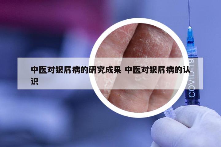 中医对银屑病的研究成果 中医对银屑病的认识