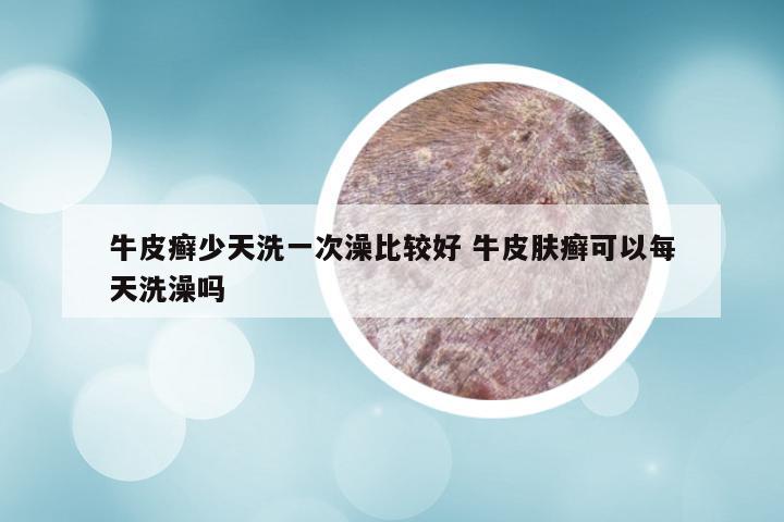 牛皮癣少天洗一次澡比较好 牛皮肤癣可以每天洗澡吗