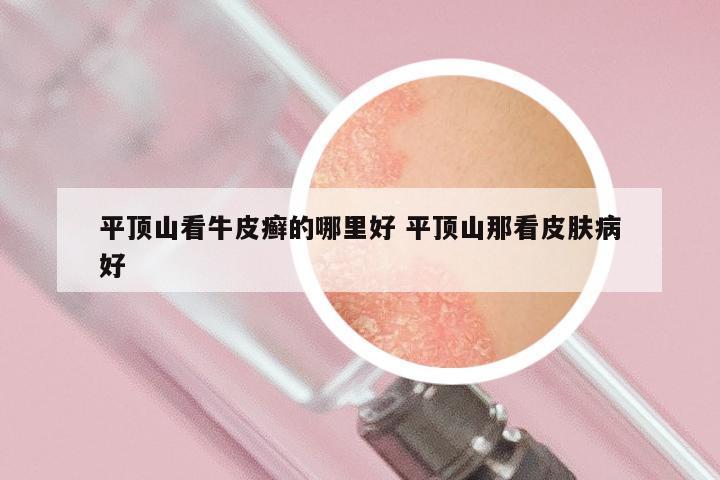 平顶山看牛皮癣的哪里好 平顶山那看皮肤病好