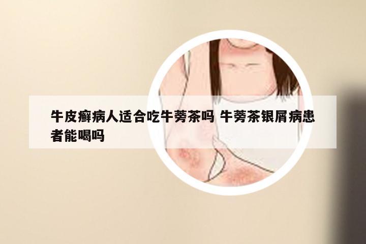 牛皮癣病人适合吃牛蒡茶吗 牛蒡茶银屑病患者能喝吗
