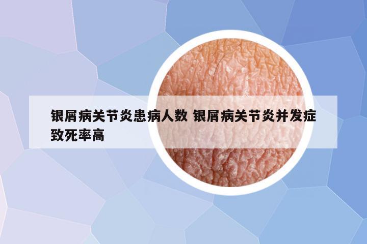 银屑病关节炎患病人数 银屑病关节炎并发症致死率高