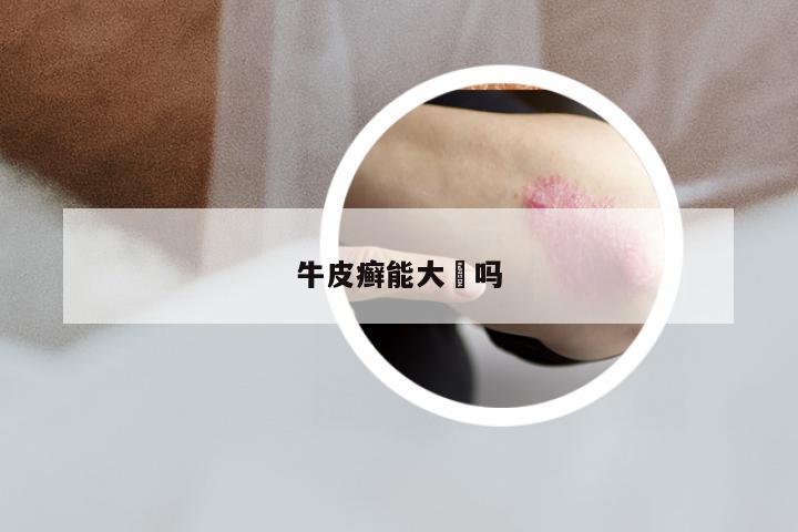 牛皮癣能大枓吗