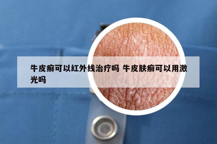 牛皮癣可以红外线治疗吗 牛皮肤癣可以用激光吗