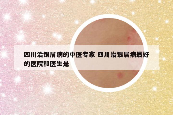 四川治银屑病的中医专家 四川治银屑病最好的医院和医生是