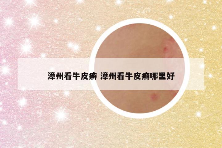 漳州看牛皮癣 漳州看牛皮癣哪里好