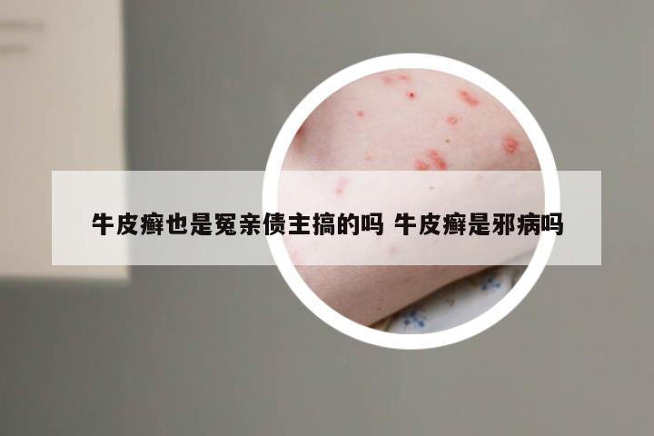 牛皮癣也是冤亲债主搞的吗 牛皮癣是邪病吗