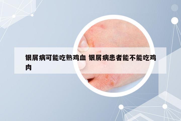 银屑病可能吃熟鸡血 银屑病患者能不能吃鸡肉