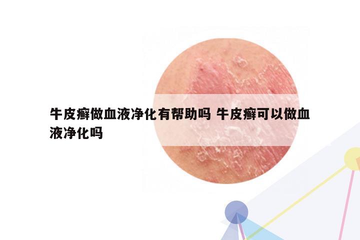 牛皮癣做血液净化有帮助吗 牛皮癣可以做血液净化吗