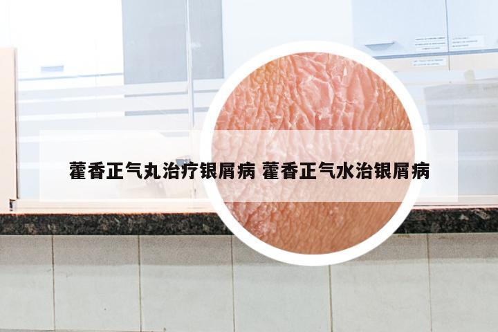 藿香正气丸治疗银屑病 藿香正气水治银屑病