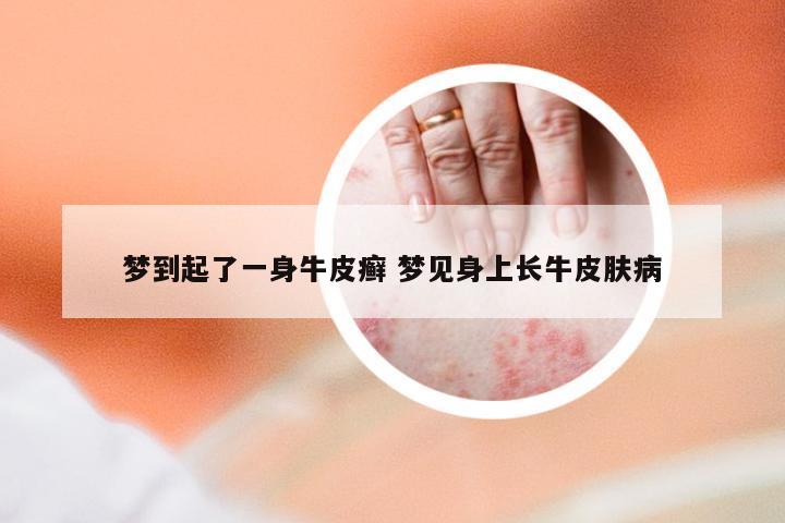 梦到起了一身牛皮癣 梦见身上长牛皮肤病