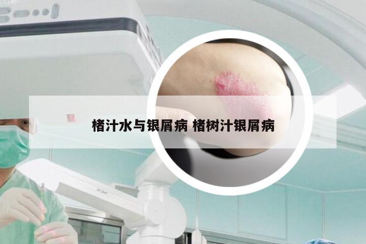 楮汁水与银屑病 楮树汁银屑病