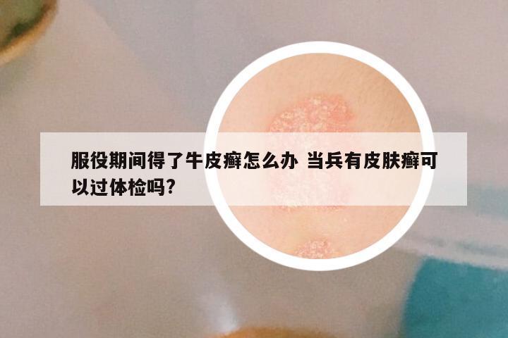 服役期间得了牛皮癣怎么办 当兵有皮肤癣可以过体检吗?