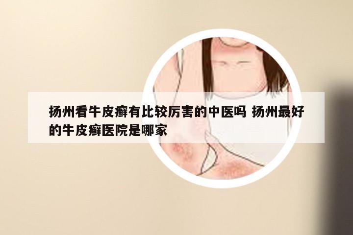 扬州看牛皮癣有比较厉害的中医吗 扬州最好的牛皮癣医院是哪家