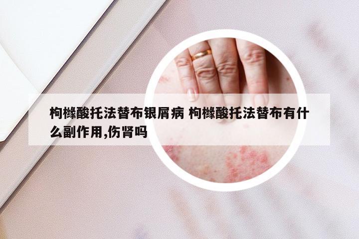 枸橼酸托法替布银屑病 枸橼酸托法替布有什么副作用,伤肾吗