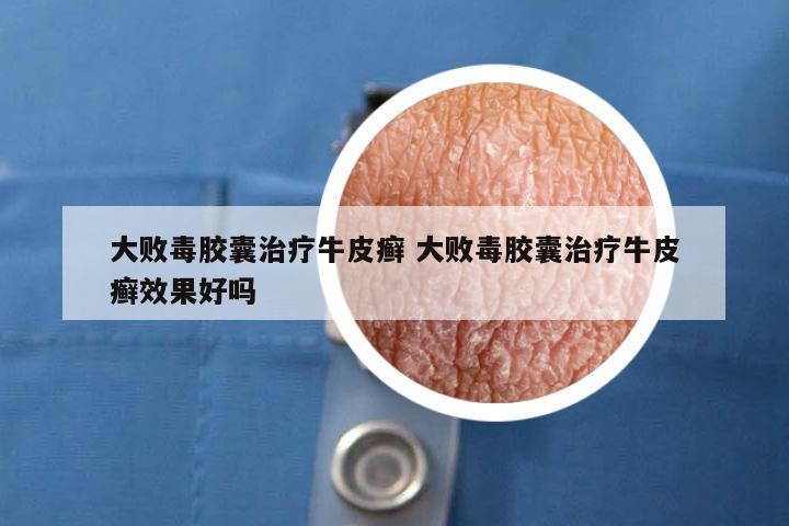 大败毒胶囊治疗牛皮癣 大败毒胶囊治疗牛皮癣效果好吗