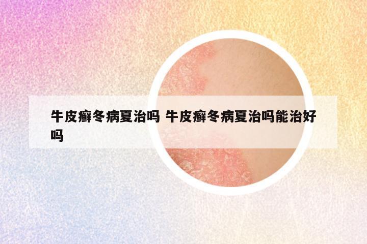 牛皮癣冬病夏治吗 牛皮癣冬病夏治吗能治好吗