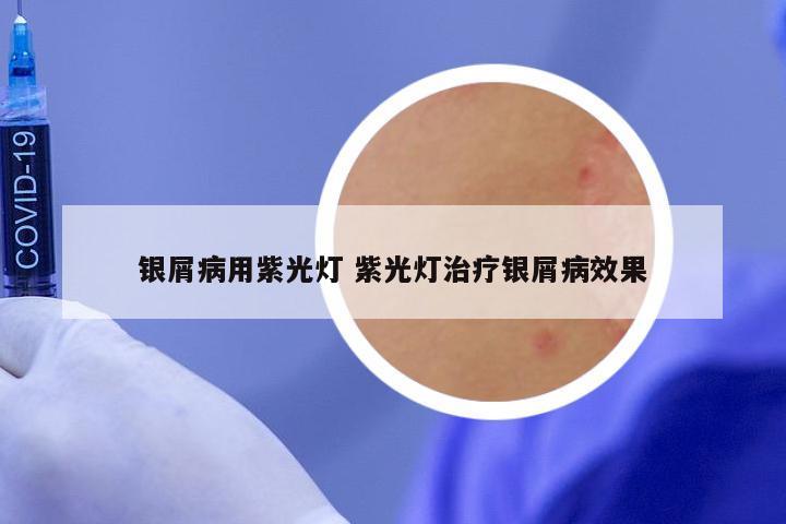 银屑病用紫光灯 紫光灯治疗银屑病效果