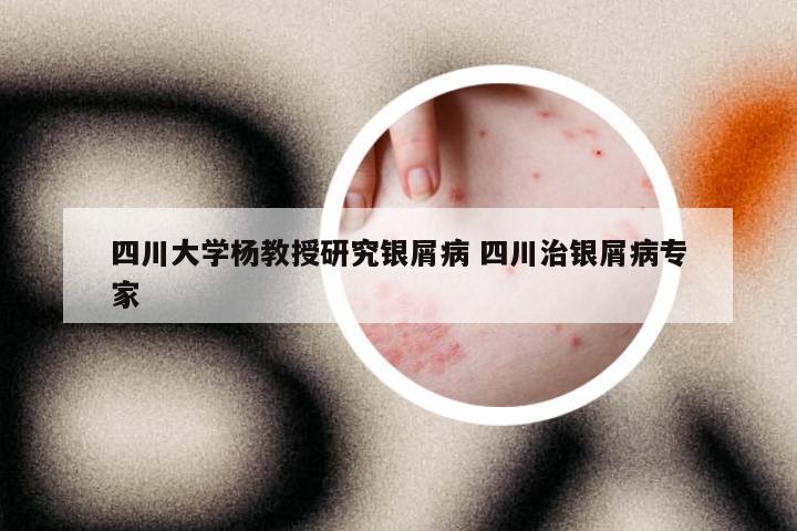 四川大学杨教授研究银屑病 四川治银屑病专家