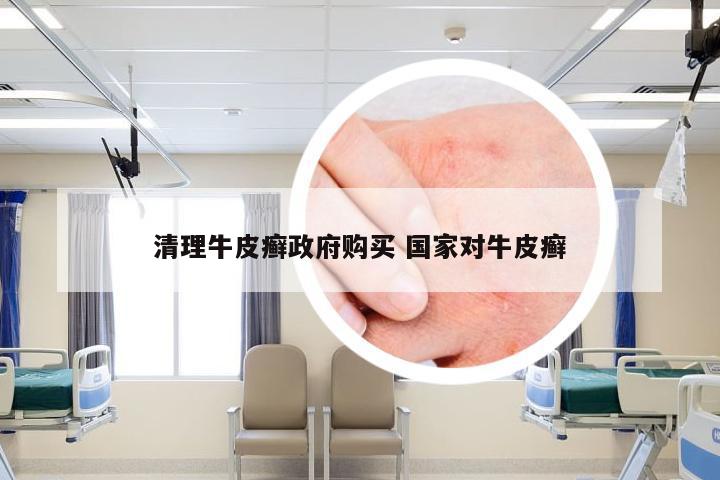 清理牛皮癣政府购买 国家对牛皮癣
