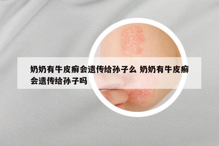 奶奶有牛皮癣会遗传给孙子么 奶奶有牛皮癣会遗传给孙子吗
