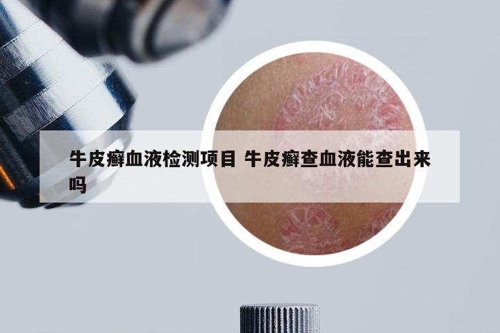 牛皮癣血液检测项目 牛皮癣查血液能查出来吗