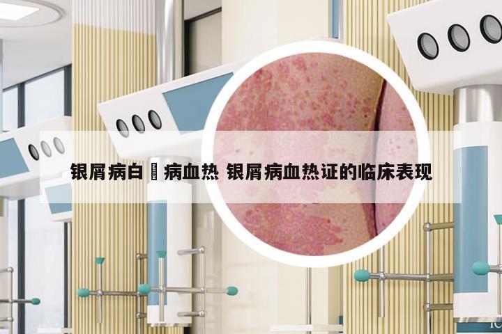 银屑病白疕病血热 银屑病血热证的临床表现