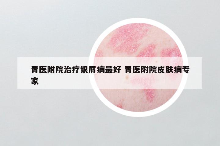 青医附院治疗银屑病最好 青医附院皮肤病专家