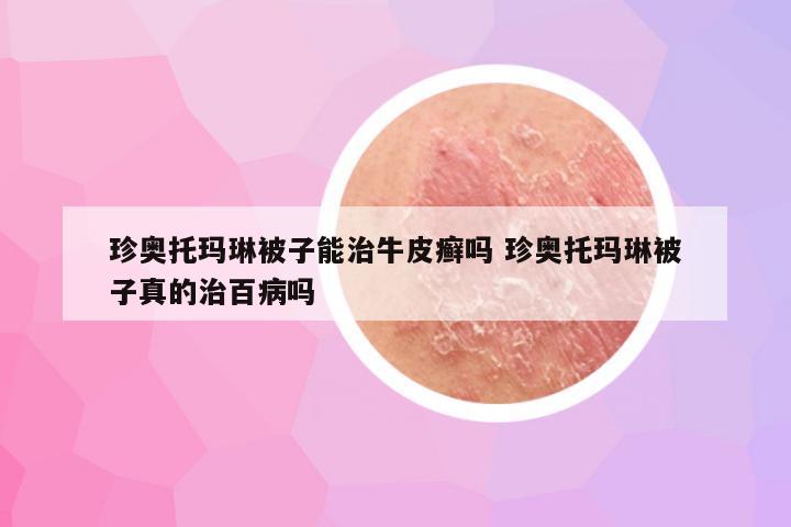 珍奥托玛琳被子能治牛皮癣吗 珍奥托玛琳被子真的治百病吗