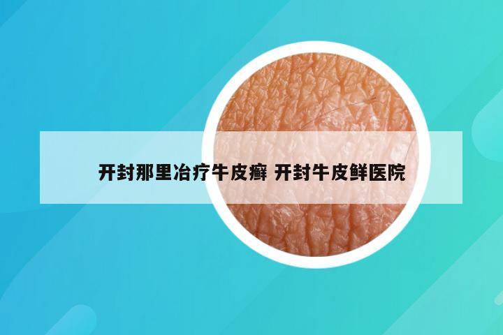 开封那里冶疗牛皮癣 开封牛皮鲜医院